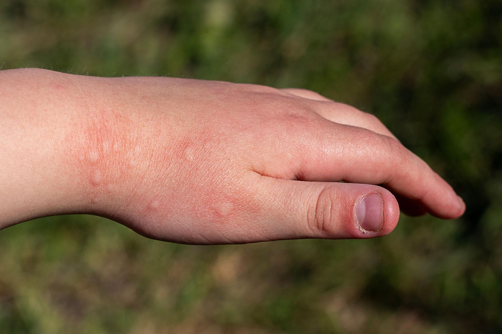 How to Stop Allergies Naturally Without Medication